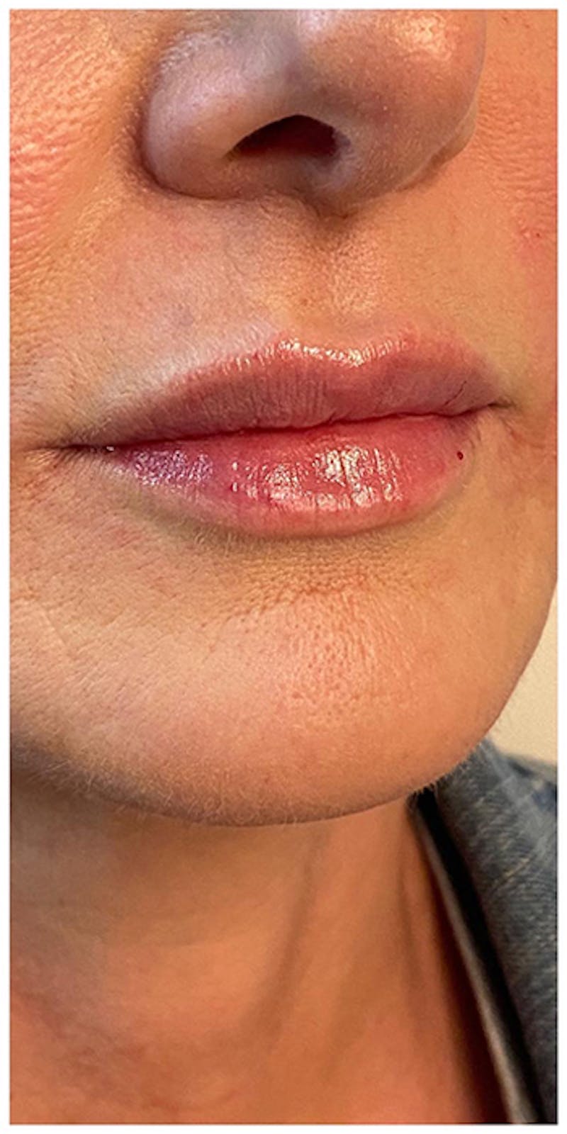 Lip Enhancement Before & After Gallery - Patient 133024219 - Image 4