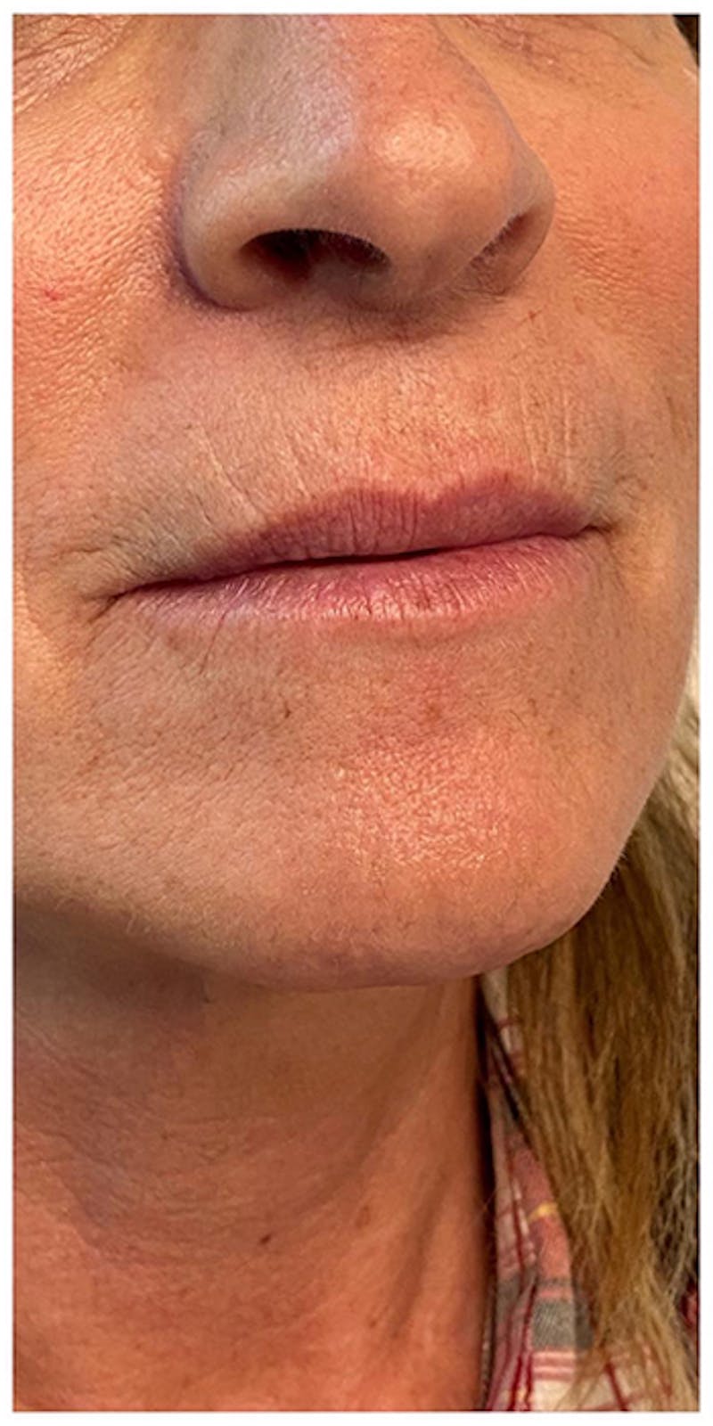 Lip Enhancement Before & After Gallery - Patient 133024227 - Image 1