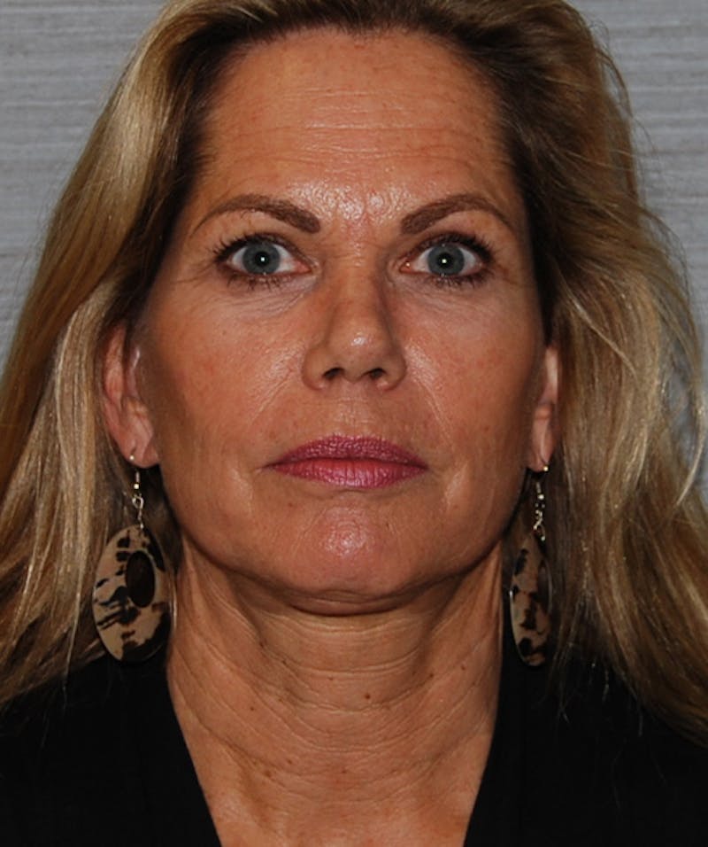 Facelift & Necklift Before & After Gallery - Patient 133024230 - Image 2