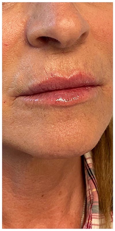 Lip Enhancement Before & After Gallery - Patient 133024227 - Image 2