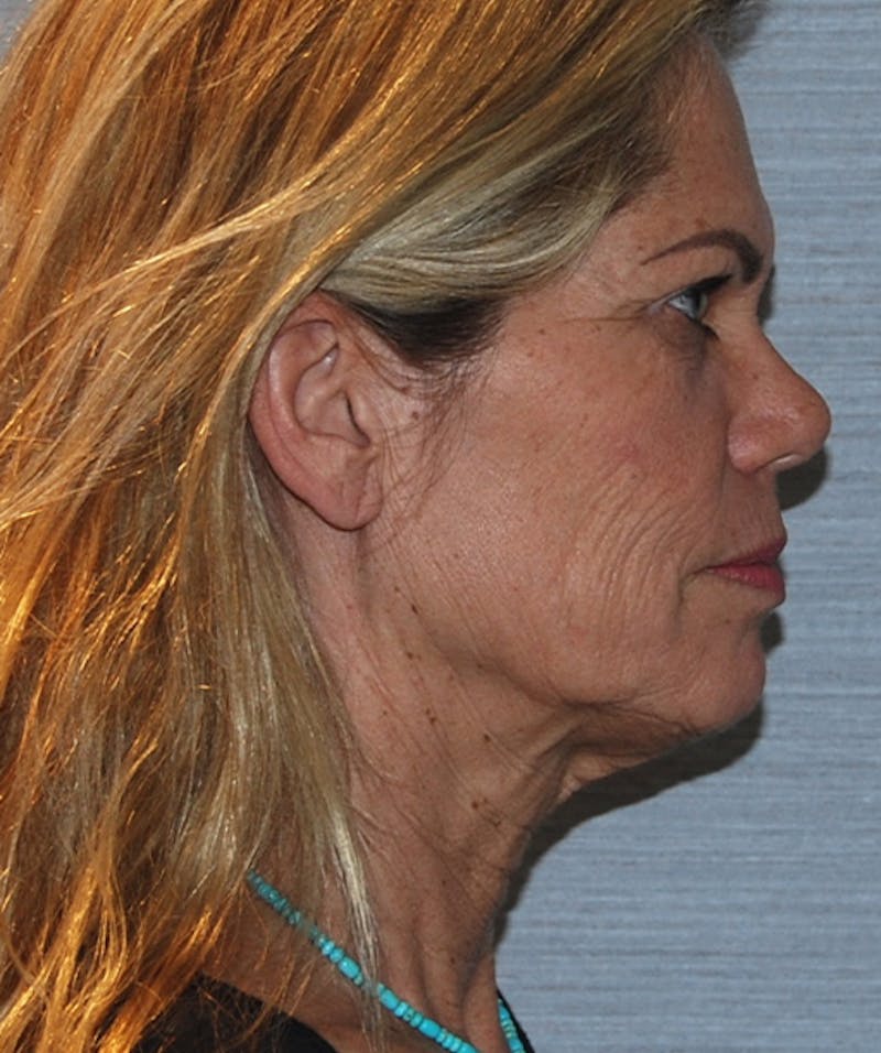 Facelift & Necklift Before & After Gallery - Patient 133024230 - Image 3