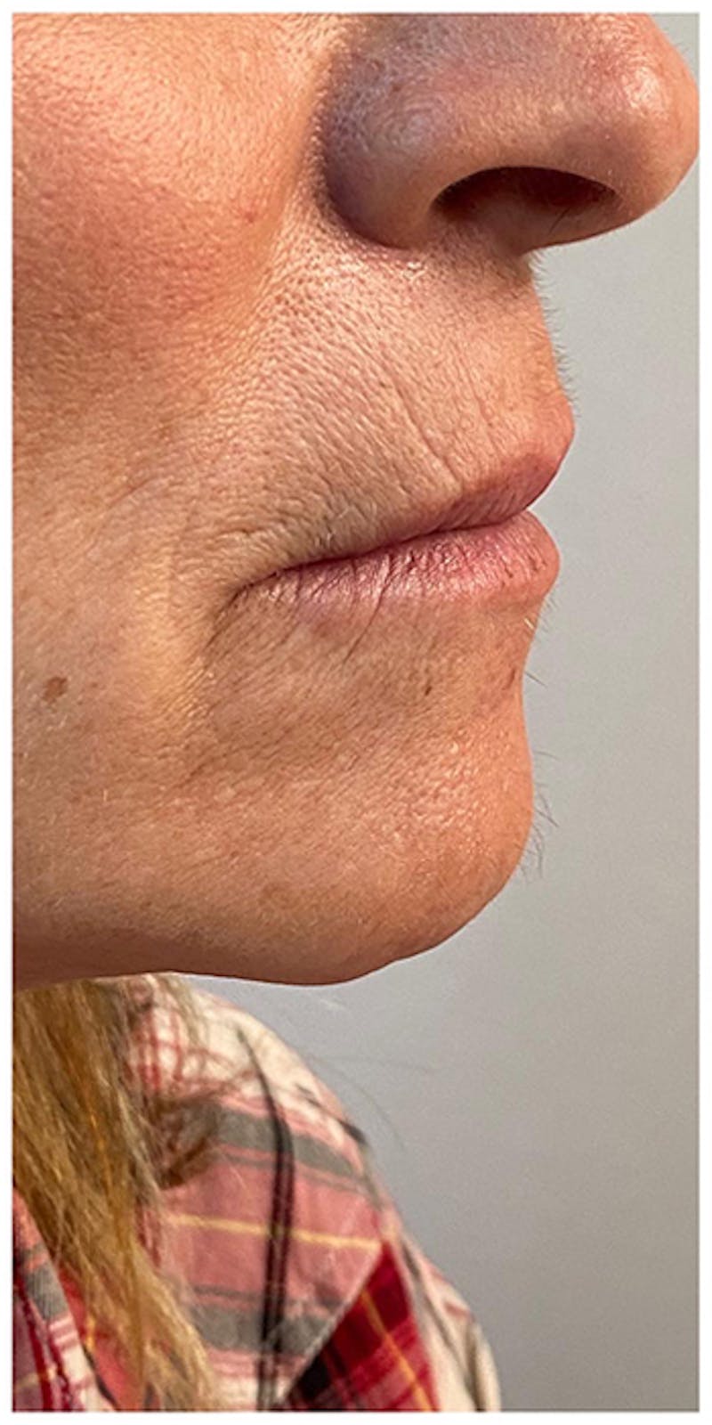 Lip Enhancement Before & After Gallery - Patient 133024227 - Image 3