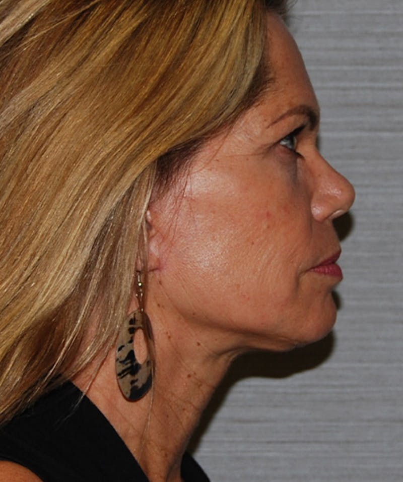 Facelift & Necklift Before & After Gallery - Patient 133024230 - Image 4