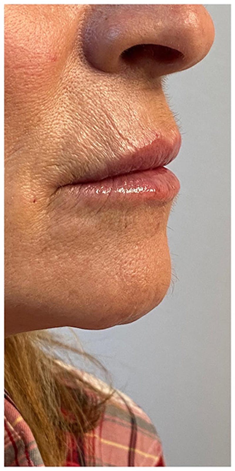 Lip Enhancement Before & After Gallery - Patient 133024227 - Image 4