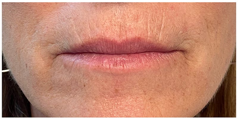 Lip Enhancement Before & After Gallery - Patient 133024227 - Image 5