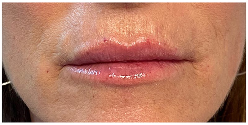 Lip Enhancement Before & After Gallery - Patient 133024227 - Image 6