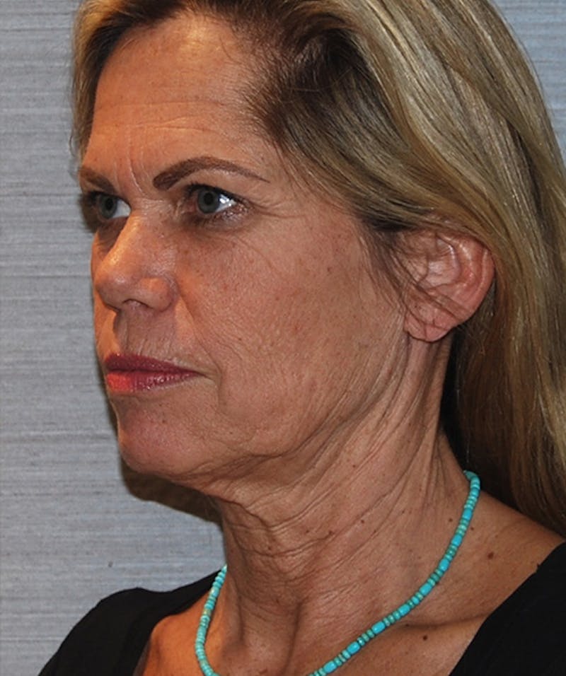 Facelift & Necklift Before & After Gallery - Patient 133024230 - Image 7
