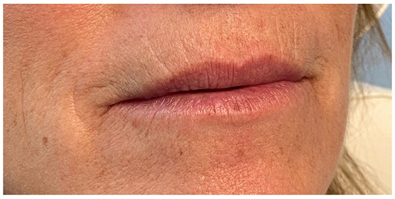 Lip Enhancement Before & After Gallery - Patient 133024227 - Image 7