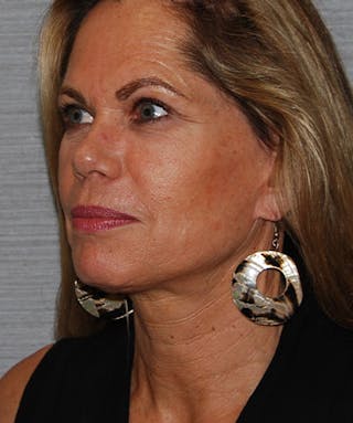 Facelift & Necklift Before & After Gallery - Patient 133024230 - Image 8