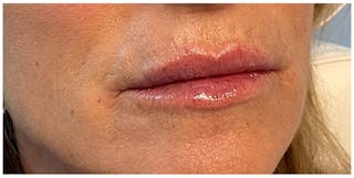 Lip Enhancement Before & After Gallery - Patient 133024227 - Image 8