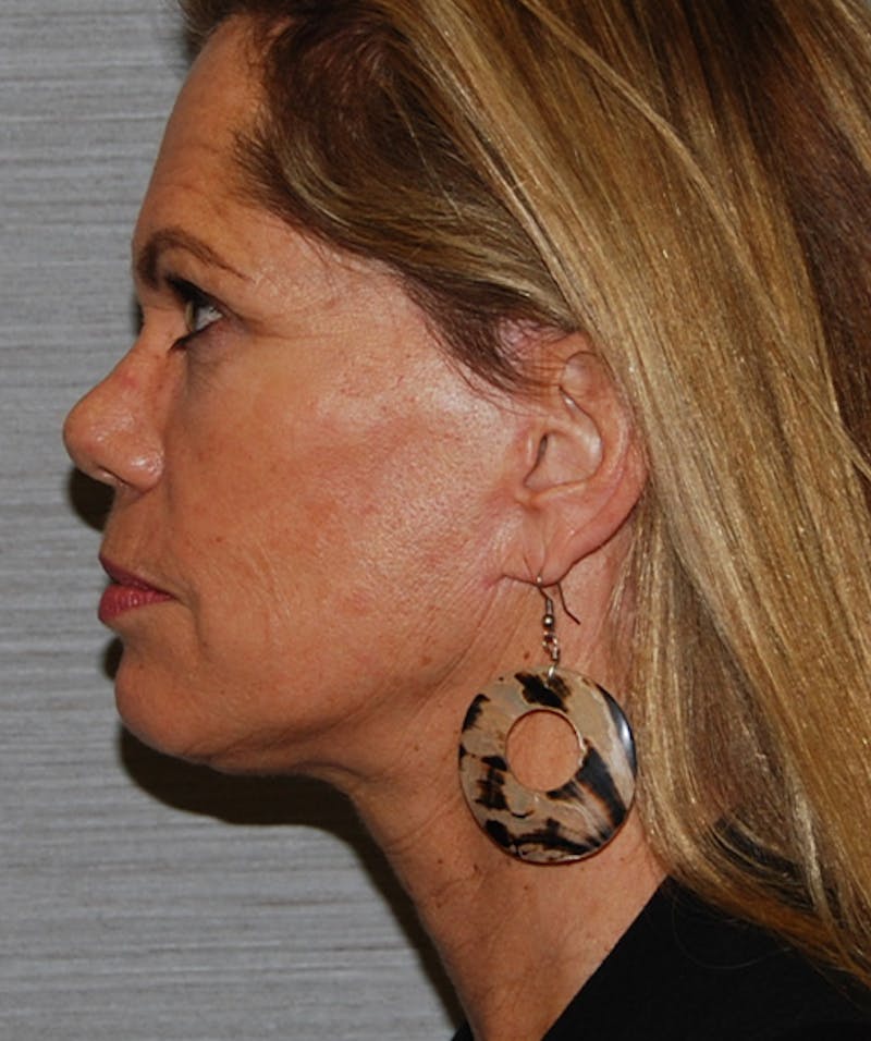 Facelift & Necklift Before & After Gallery - Patient 133024230 - Image 10