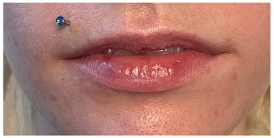 Lip Enhancement Before & After Gallery - Patient 133024233 - Image 1