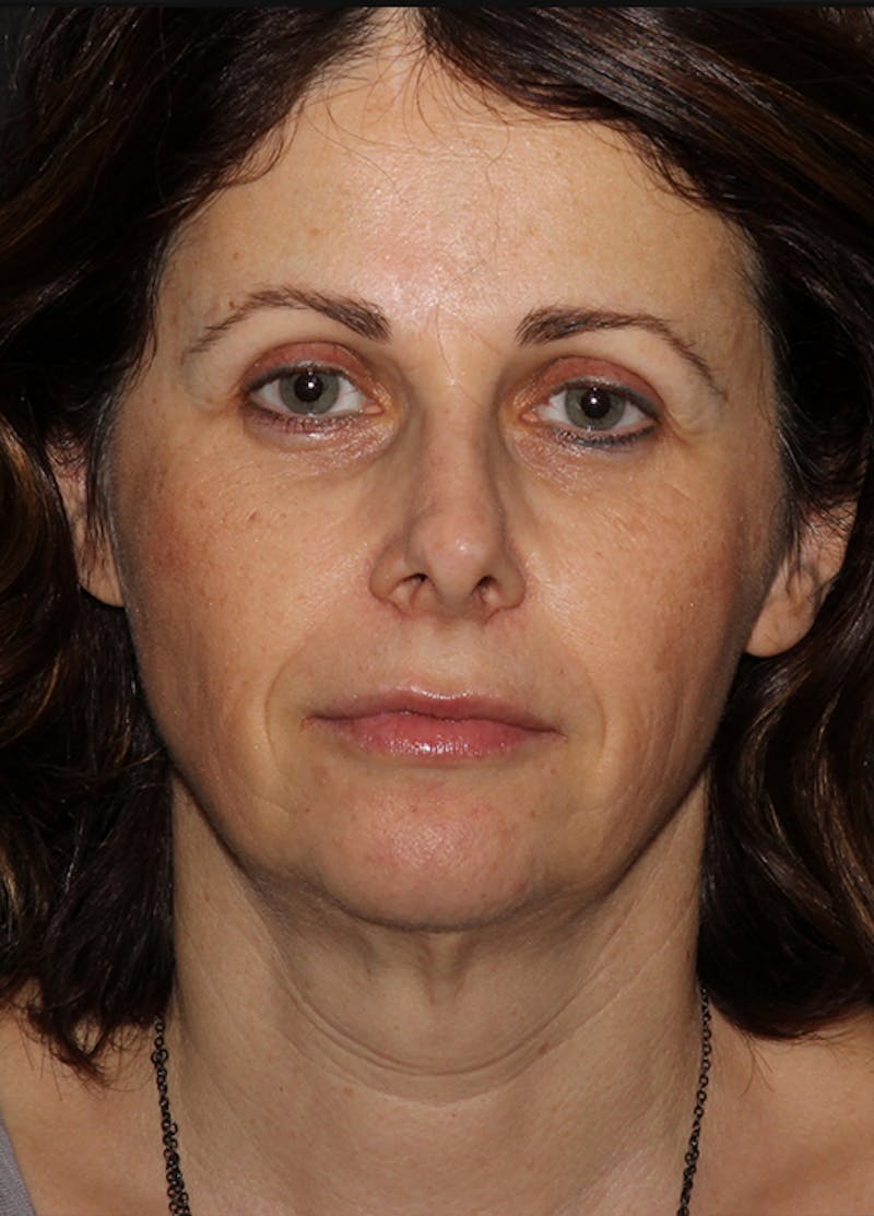 Facelift & Necklift Before & After Gallery - Patient 133024237 - Image 1