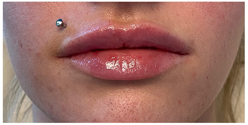 Lip Enhancement Before & After Gallery - Patient 133024233 - Image 2