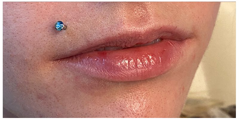 Lip Enhancement Before & After Gallery - Patient 133024233 - Image 3