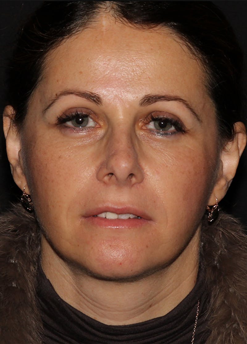 Facelift & Necklift Before & After Gallery - Patient 133024237 - Image 2