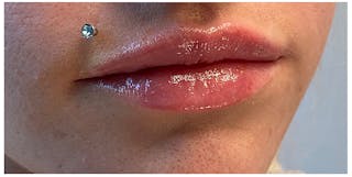 Lip Enhancement Before & After Gallery - Patient 133024233 - Image 4