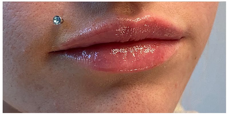 Lip Enhancement Before & After Gallery - Patient 133024233 - Image 4
