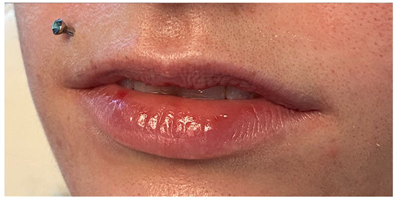 Lip Enhancement Before & After Gallery - Patient 133024233 - Image 5