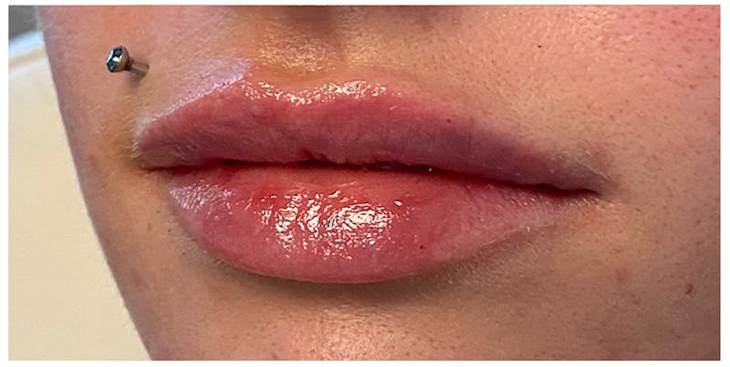 Lip Enhancement Before & After Gallery - Patient 133024233 - Image 6