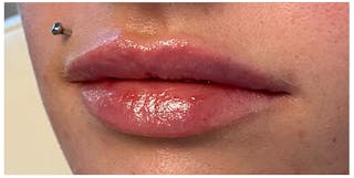 Lip Enhancement Before & After Gallery - Patient 133024233 - Image 6