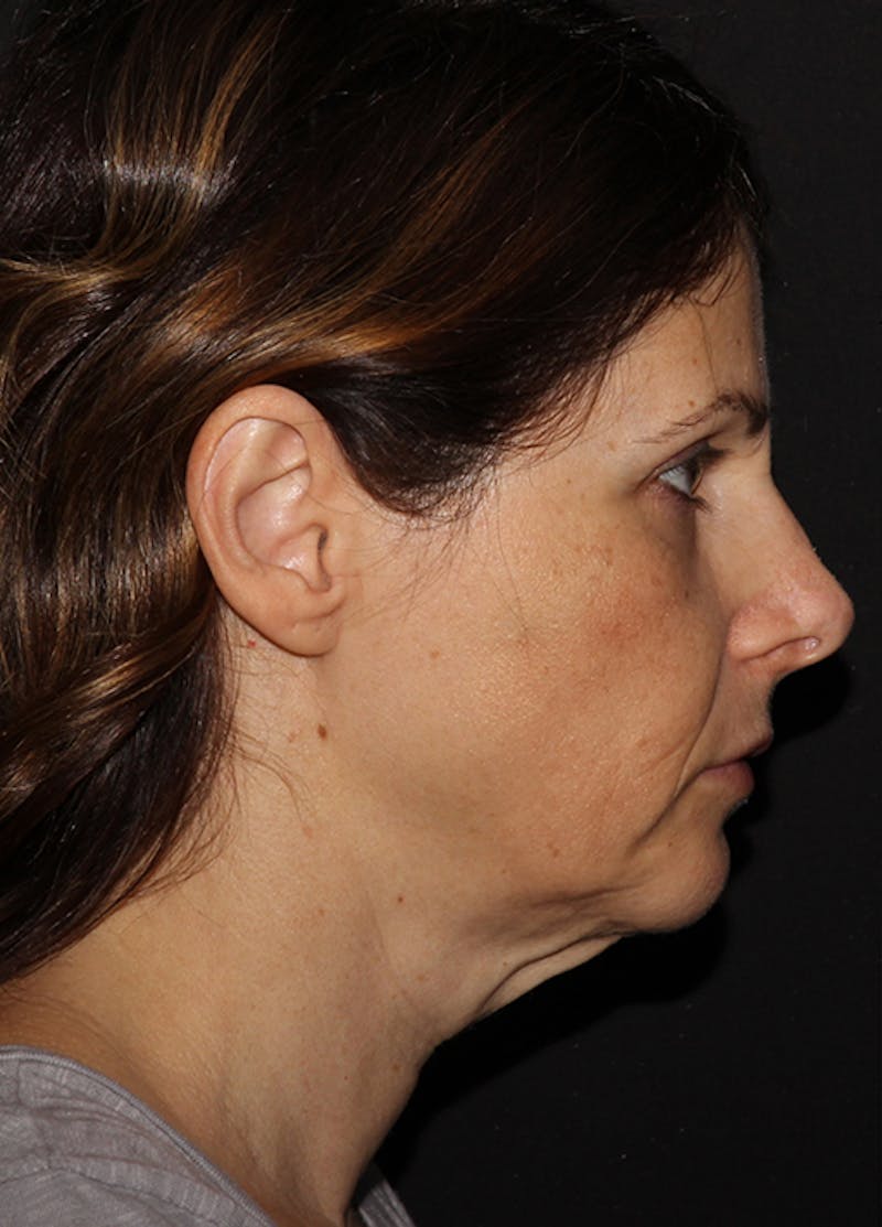 Facelift & Necklift Before & After Gallery - Patient 133024237 - Image 5