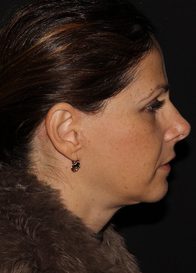 Facelift & Necklift Before & After Gallery - Patient 133024237 - Image 6