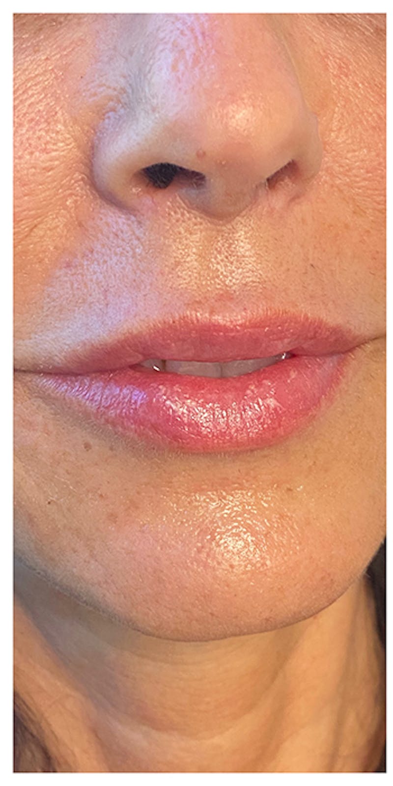 Lip Enhancement Before & After Gallery - Patient 133024238 - Image 1