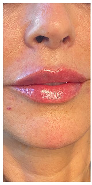 Lip Enhancement Before & After Gallery - Patient 133024238 - Image 2