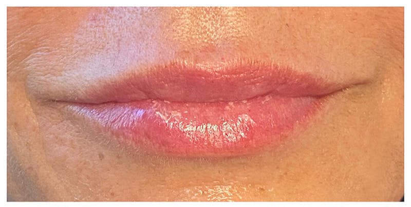 Lip Enhancement Before & After Gallery - Patient 133024238 - Image 3
