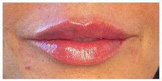 Lip Enhancement Before & After Gallery - Patient 133024238 - Image 4