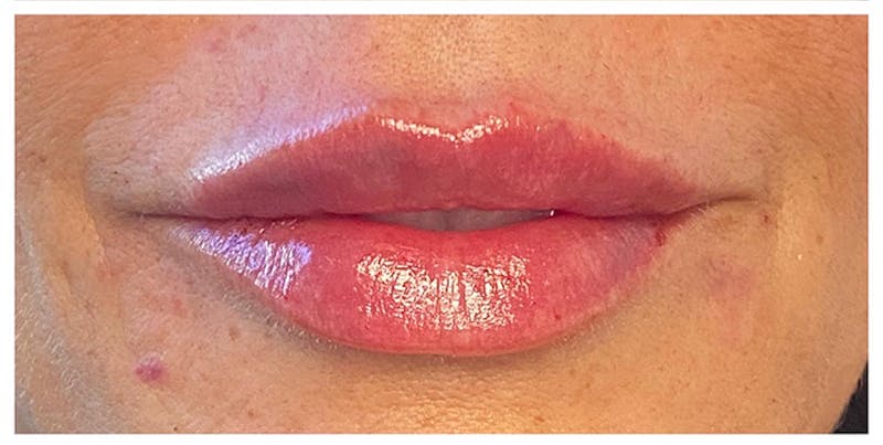 Lip Enhancement Before & After Gallery - Patient 133024238 - Image 4