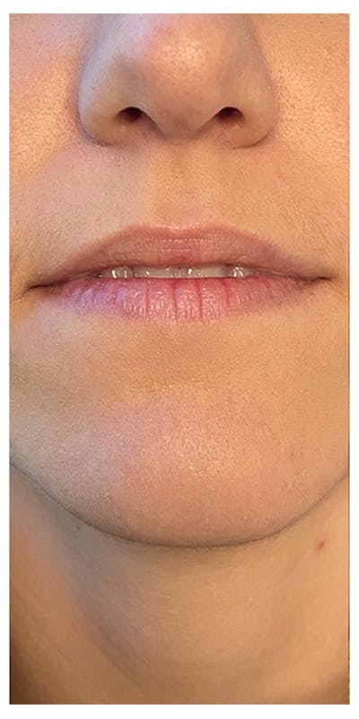 Lip Enhancement Before & After Gallery - Patient 133024244 - Image 1