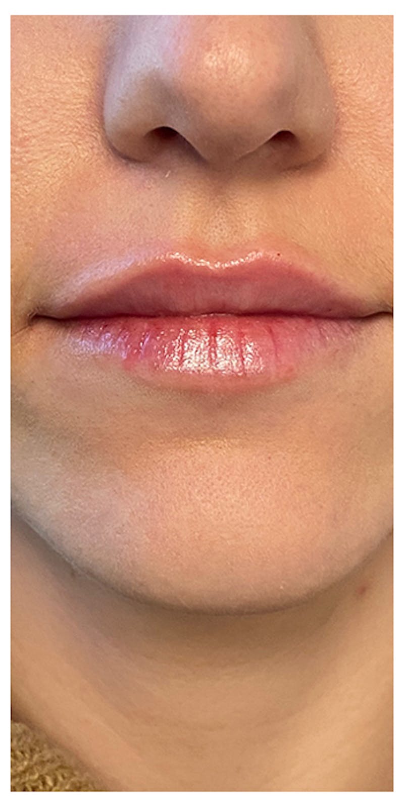 Lip Enhancement Before & After Gallery - Patient 133024244 - Image 2
