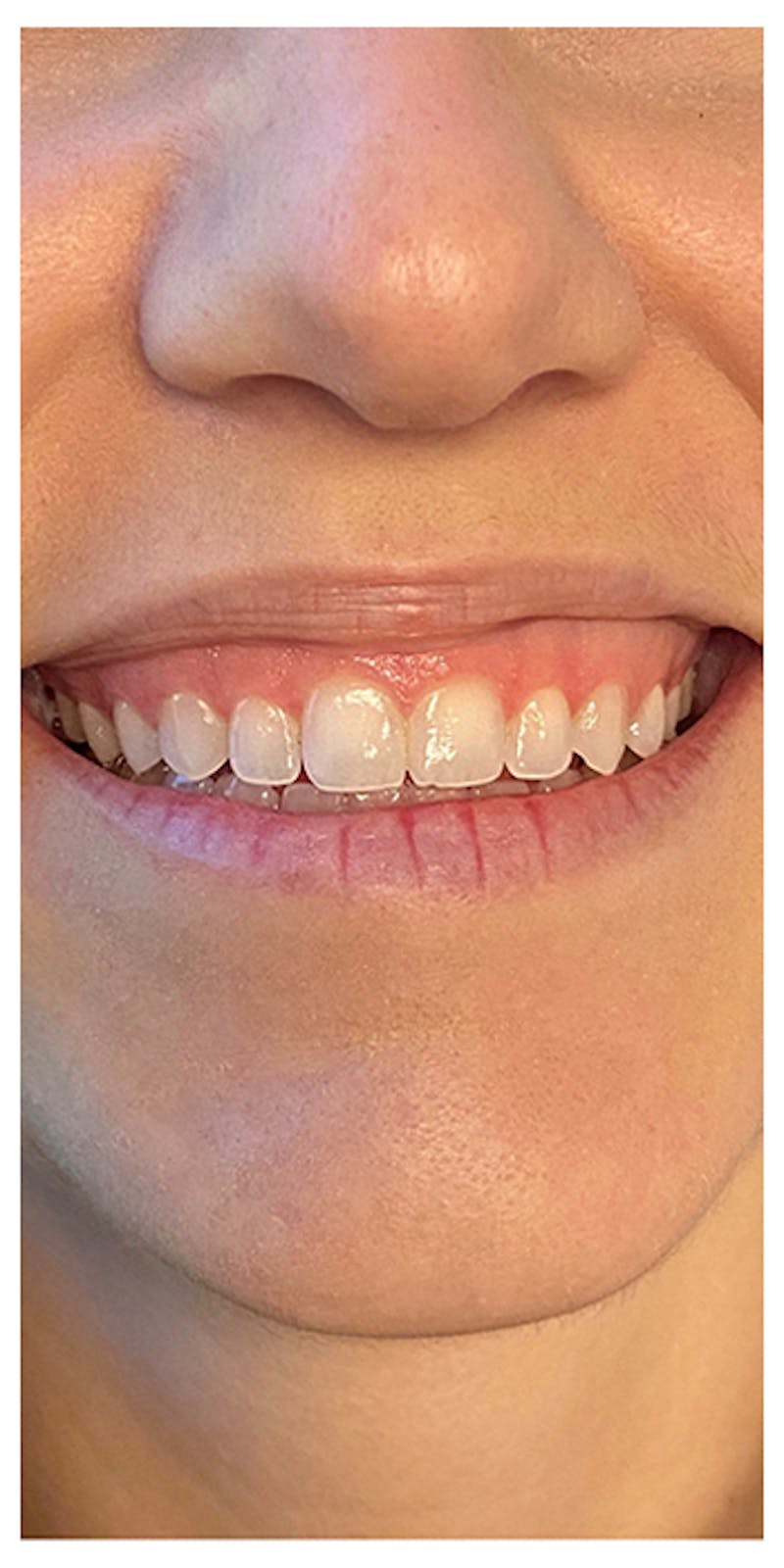 Lip Enhancement Before & After Gallery - Patient 133024244 - Image 3