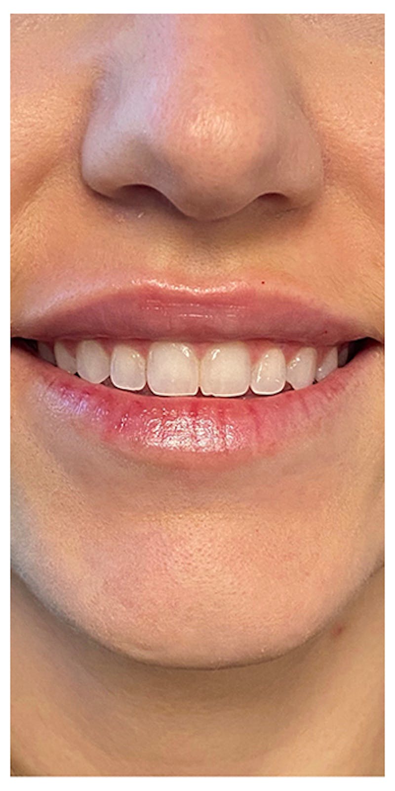 Lip Enhancement Before & After Gallery - Patient 133024244 - Image 4