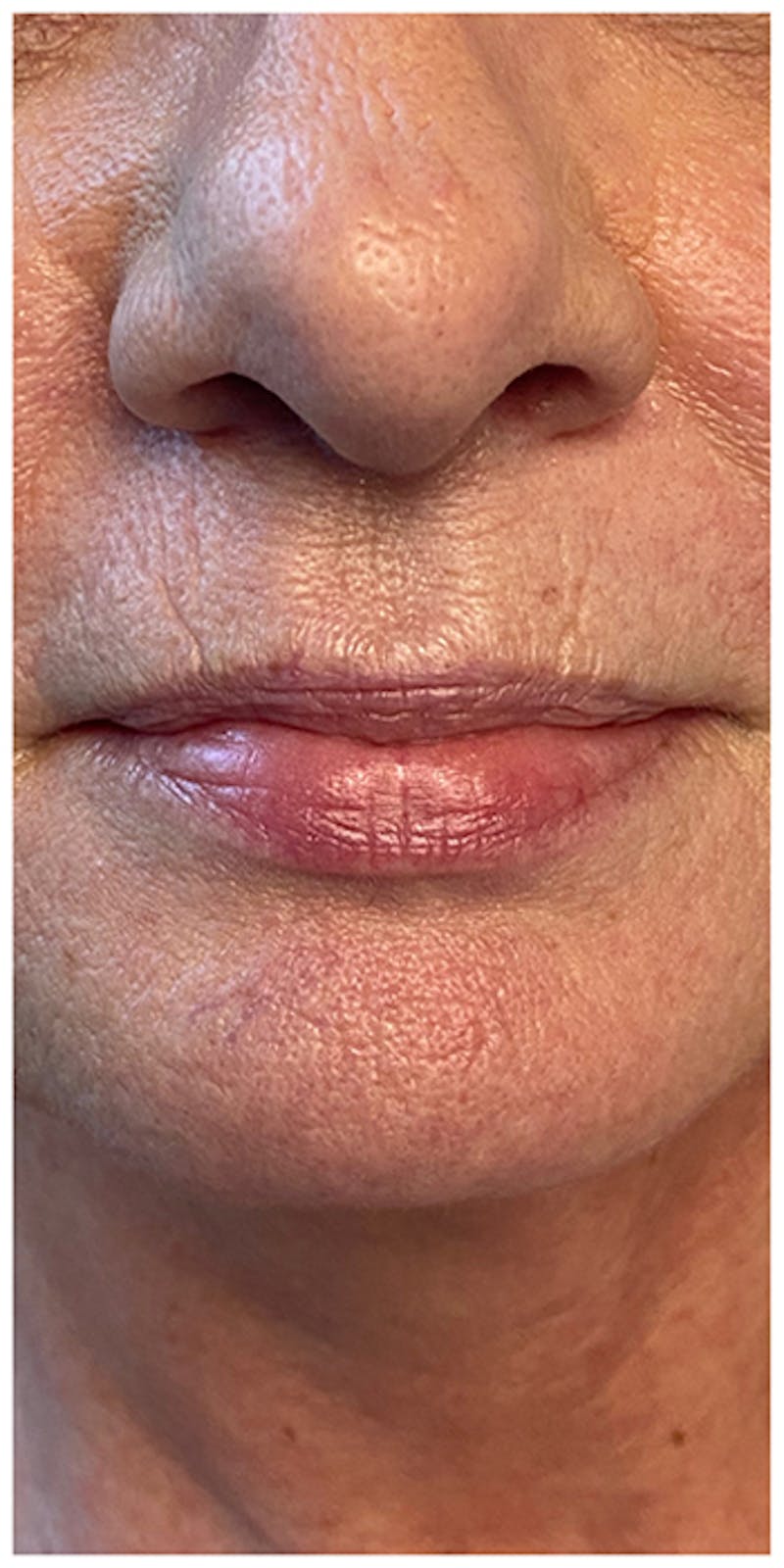 Lip Enhancement Before & After Gallery - Patient 133024252 - Image 1