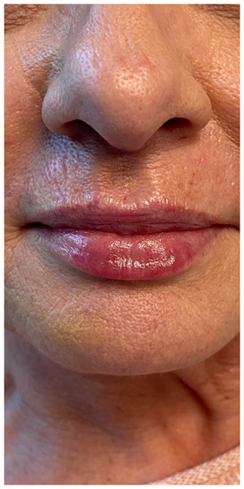 Lip Enhancement Before & After Gallery - Patient 133024252 - Image 2