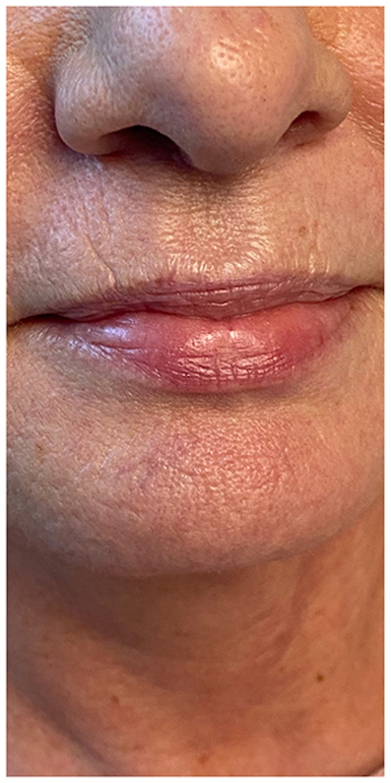 Lip Enhancement Before & After Gallery - Patient 133024252 - Image 3