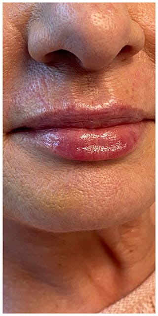Lip Enhancement Before & After Gallery - Patient 133024252 - Image 4