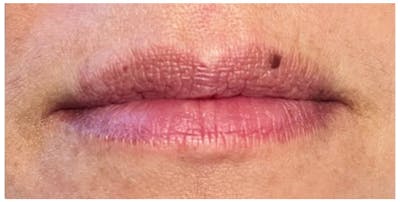 Lip Enhancement Before & After Gallery - Patient 133024266 - Image 1