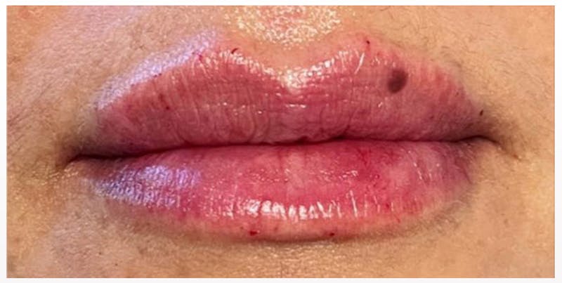 Lip Enhancement Before & After Gallery - Patient 133024266 - Image 2