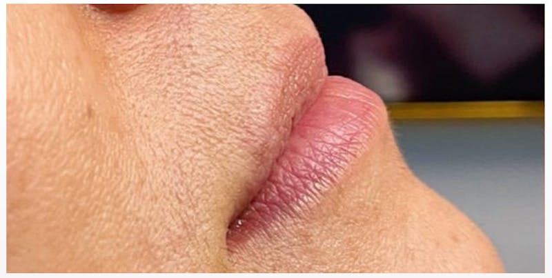 Lip Enhancement Before & After Gallery - Patient 133024266 - Image 3
