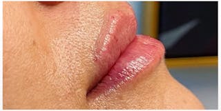 Lip Enhancement Before & After Gallery - Patient 133024266 - Image 4