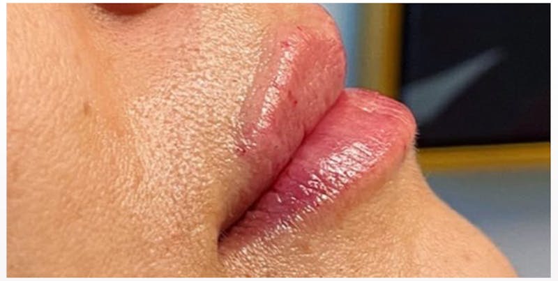 Lip Enhancement Before & After Gallery - Patient 133024266 - Image 4