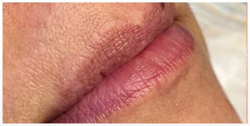 Lip Enhancement Before & After Gallery - Patient 133024266 - Image 5