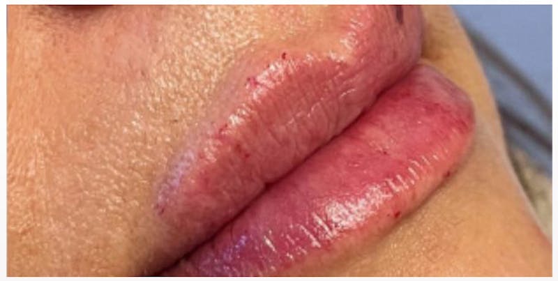 Lip Enhancement Before & After Gallery - Patient 133024266 - Image 6