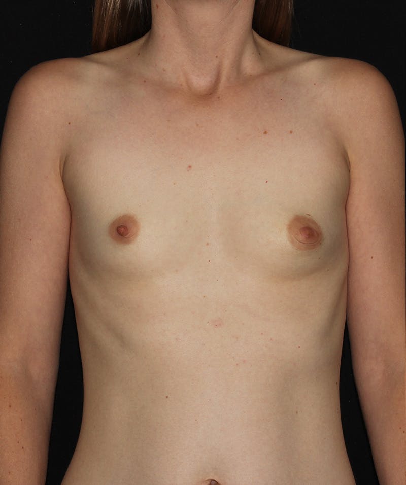Breast Augmentation Before & After Gallery - Patient 187735645 - Image 1
