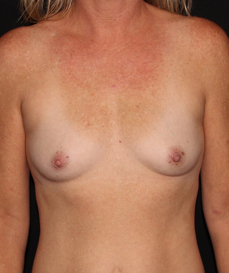 Breast Augmentation Before & After Gallery - Patient 187749725 - Image 1