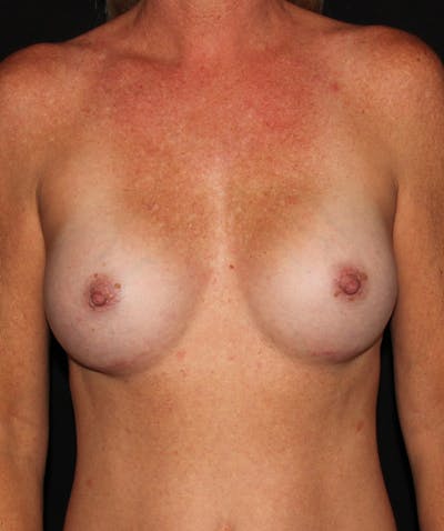 Breast Augmentation Before & After Gallery - Patient 187749725 - Image 2